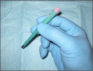 Figure 1 A 2mm punch biopsy. This technique is used for epidermal nerve fiber density testing, however a 3mm punch in necessary in that context (courtesy Carl Solomon, DPM).