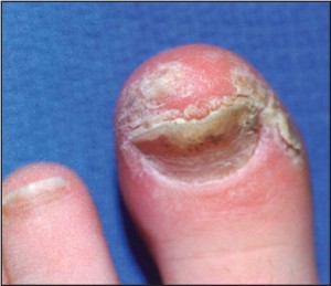 Figure 1: Psoriatic nail involvement most commonly presents as a keratinizing nail unit dystrophy (Courtesy Sean VanMarter, DPM).
