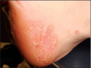 Figure 6: Acral plaques may be poorly demarcated with erythema and a fine scale (courtesy BenWeaver, DPM).