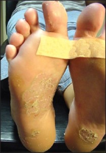 Figure 7: Acral psoriasis may present as coin-shaped lesions reminiscent of nummular (eczematous) dermatitis (courtesy Barry Blass, DPM).