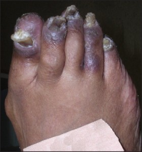 Figure 8: Some cases of acral psoriasis may be limited to the forefeet (courtesy Bruce Theall, DPM).