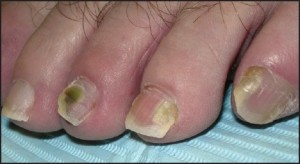 Figure 9: Psoriatic nail involvementmay be seen in isolation.