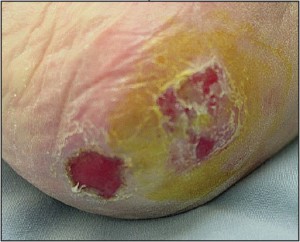 Figure 10 Neoplastic ulcers may closely resemble those that have medical etiologies.Such lesions may be easily sampled with a central and peripheral punch biopsy.