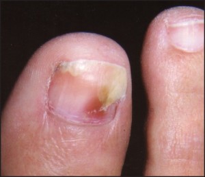 Figure 2: “Oil pits” may be seen in the lower extremity; however, they more commonly manifest on the fingers (courtesy Andrew Levy, DPM).