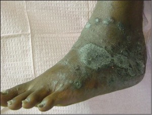 Figure 3a: Chronic plaque form psoriasis may affect the feet in its classic form, particularly on the dorsal surfaces (courtesy Brenna Steinberg, DPM).