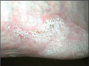 Figure 3b: Occasionally plantar lesions may also demonstrate the classic silver scales (courtesy Don Heilala, DPM).