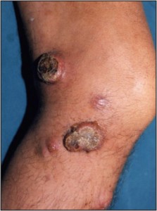 Figure 11 Advanced superficial neoplasms such as thismelanoma are sampled to precisely characterize a knownmalignancy.