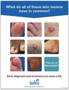 BakoDx Skin Cancer Mini Poster