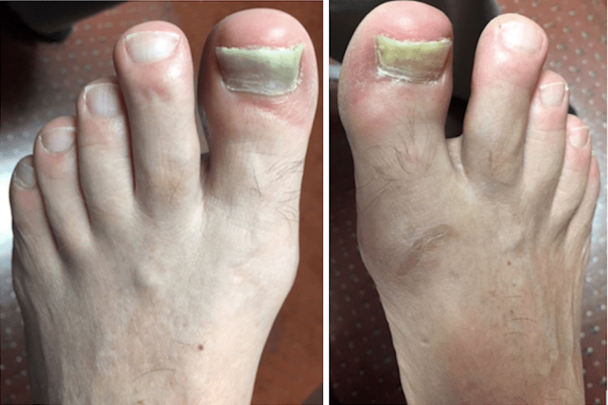 Chronic Fungal Nail Treatments - A Case Study - Compleet Feet